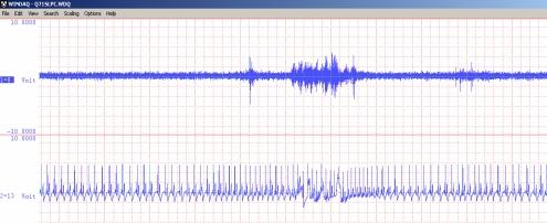EMG Sampling frequency = 250 Hz Window width ~ 95 sec EKG EEG Thorax Figure 4: The identification of an