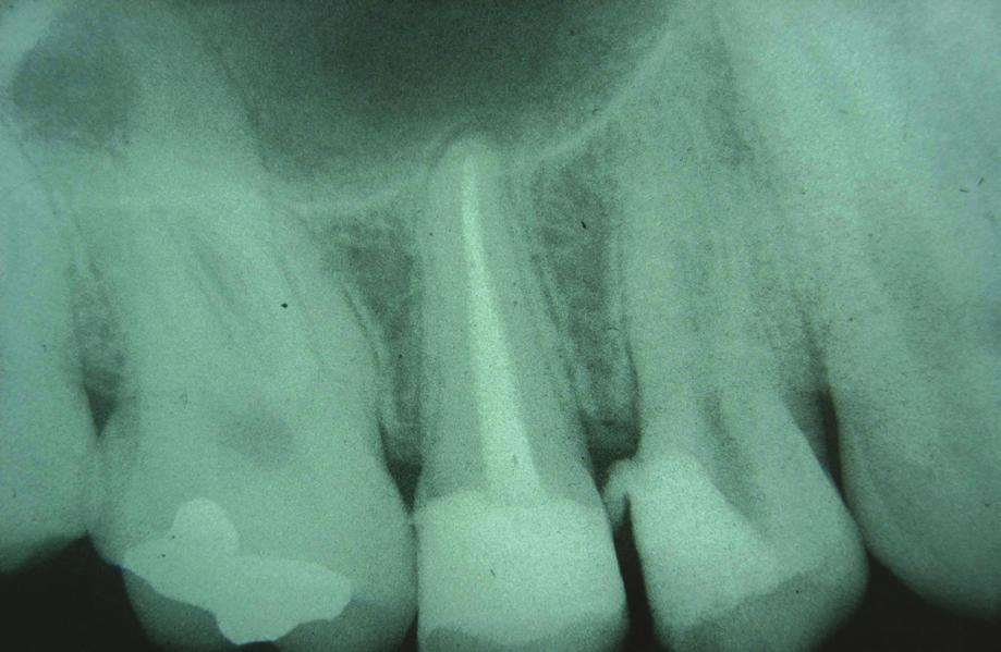 Arisu, Alacam similar anatomy to that of adjacent maxillary molars.