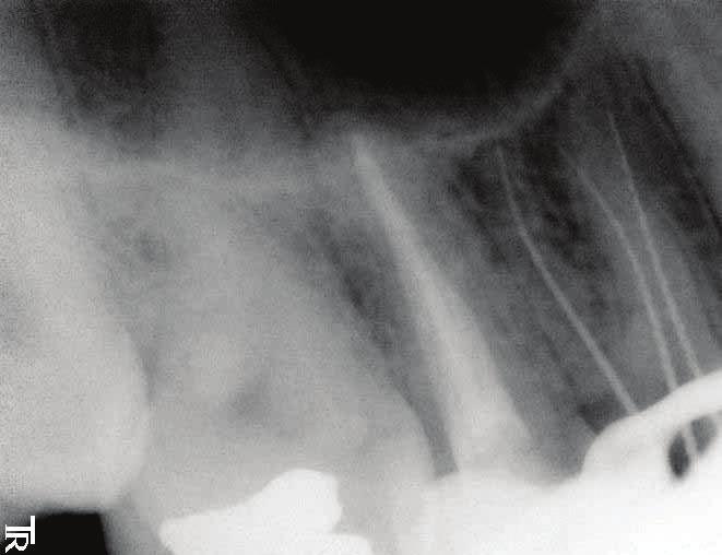 Diagnosis and treatment of three-rooted maxillary premolars entrance of the buccal canals to the cavo-surface angle resulting in a cavity with a T-shaped outline as described by Balleri et al 17