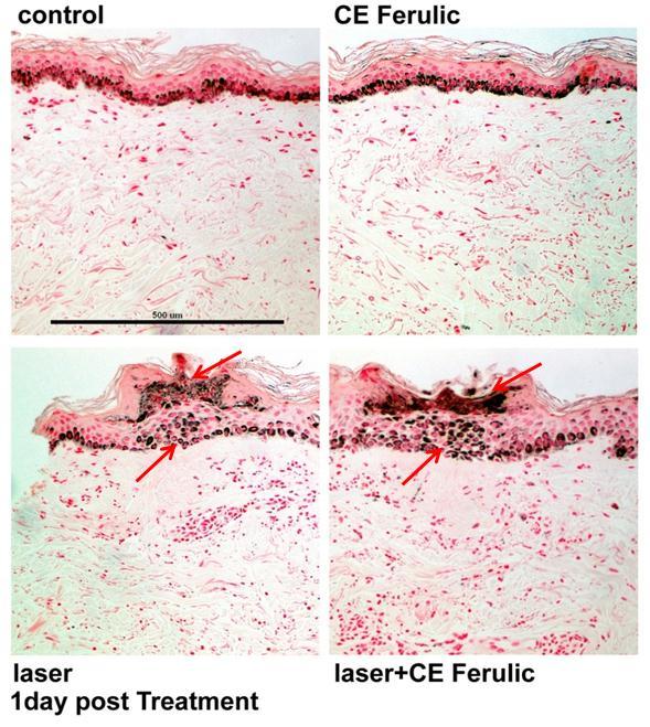 Efficacy with removal of melanin Results from forearm biopsy studies showed increased pigment removal with 1927 nm laser treatment and the use of C E Ferulic in comparison with the untreated control,