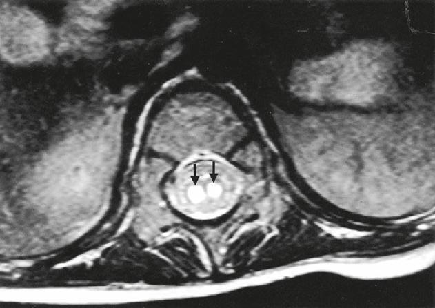 EV71 in Taiwan 107 A Figure 2 MRI of an EV71 polio-like case. Hyperintense lesions (arrows) are seen in the anterior horn of the spinal cord on T2-weighted image.