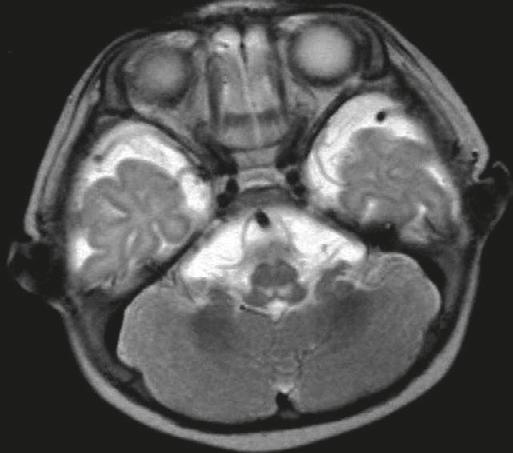 EV71 cases with poliomyelitis-like syndrome have asymmetric acute limb weakness and decreased reflexes, with no disturbance of limb sensation.