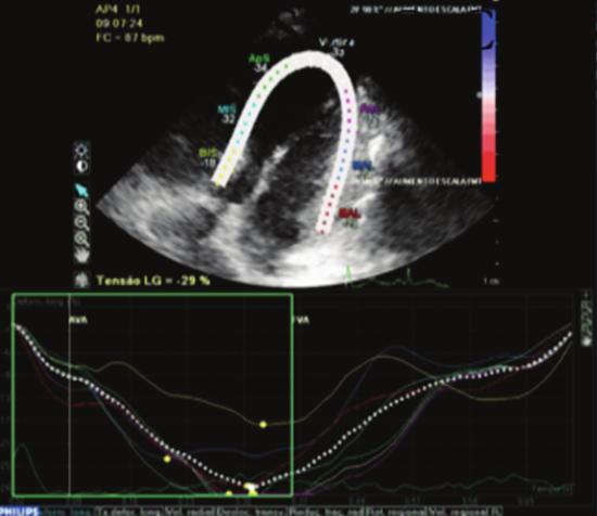 Case Reports in Hepatology 3 (a) Figure 1: Speckle tracking echocardiogram with Doppler.