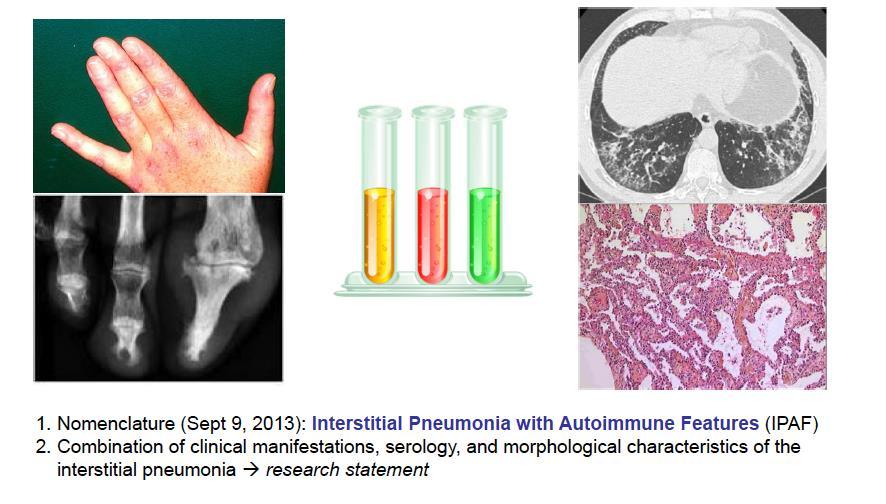 Interstitial Pneumonia with Autoimmune