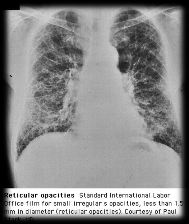 This is reticular diffuse lung infiltration on CXR, indicate marked diffuse
