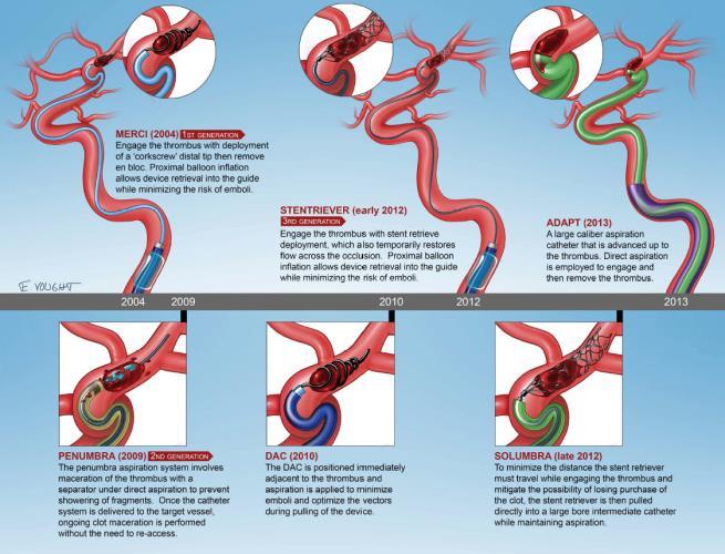 Background Evolution of Thrombectomy Approaches and