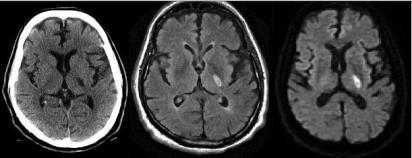 Small vessel occlusion? Small Vessel Stroke Lacunar Infarction: small subcortical infarcts that result from occlusion of a single perforating artery.