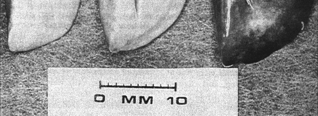 1974 Nov;110(5):556-65 Ventilator Induced Lung Injury Tidal Volume or PEEP?