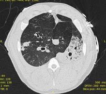 Volutrauma leads to higher lung