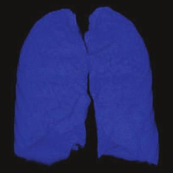 lung on both inspiratory and expiratory scans (relative volume n 950 = lung volume with attenuation values between 950 H and each threshold value / volume with attenuation value of 500 to 950 H; for