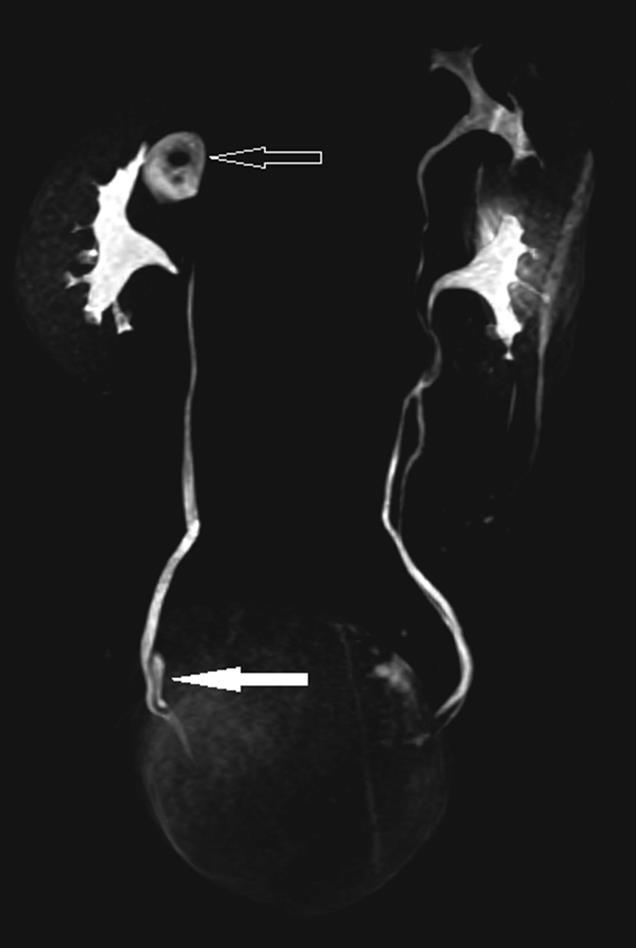 SYNONYM: T1-weighted MRU TECHNIQUES: roughly analogous to CT urography and conve