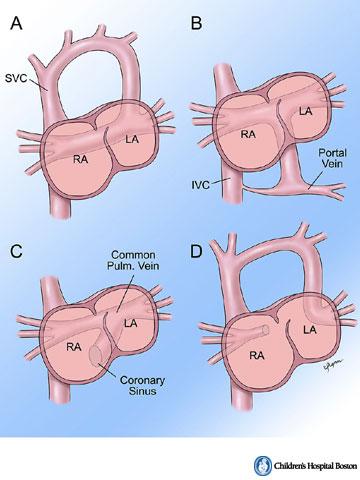 Total anomalous pulmonary venous return (TAPVR) is a description for congenital heart defects where all 4 pulmonary veins fail to connect to the left atrium but drain instead via remnants of the