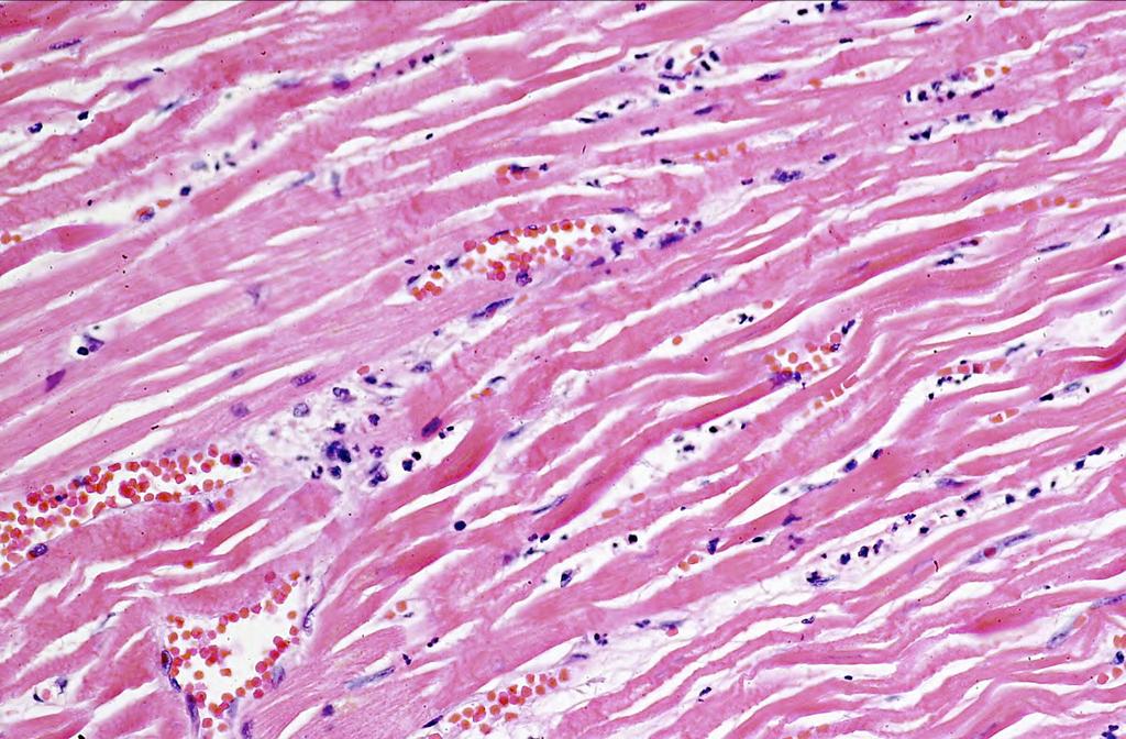 Viable cells Myocardial infarction (12-24 hours). Neutrophils (e.g. black arrows) start to infiltrate the dead myocardium as part of an acute inflammatory response to tissue injury.