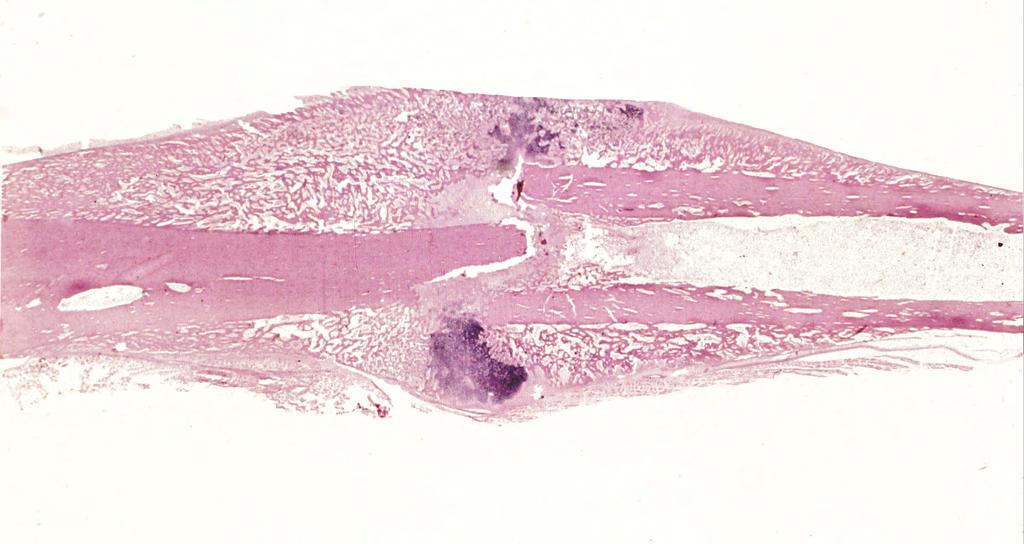 External callus Cortical bone Medullary cavity Healing of a fracture (here from a rabbit, very low power) occurs by the formation of callus.