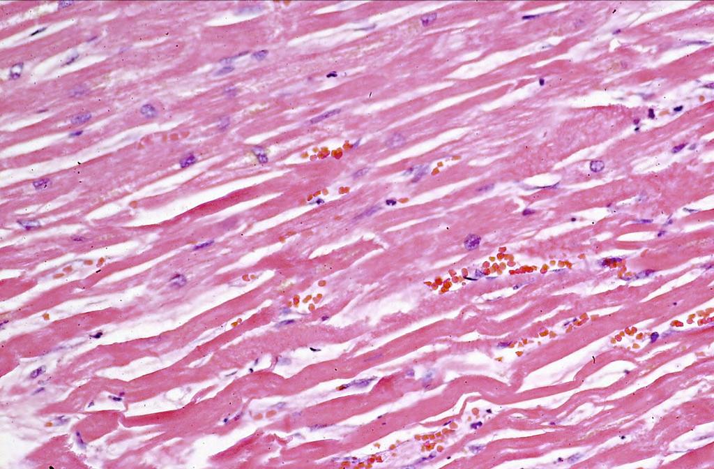 increased eosinophilic staining of infarcted cells compared to viable cells due to coagulated proteins.