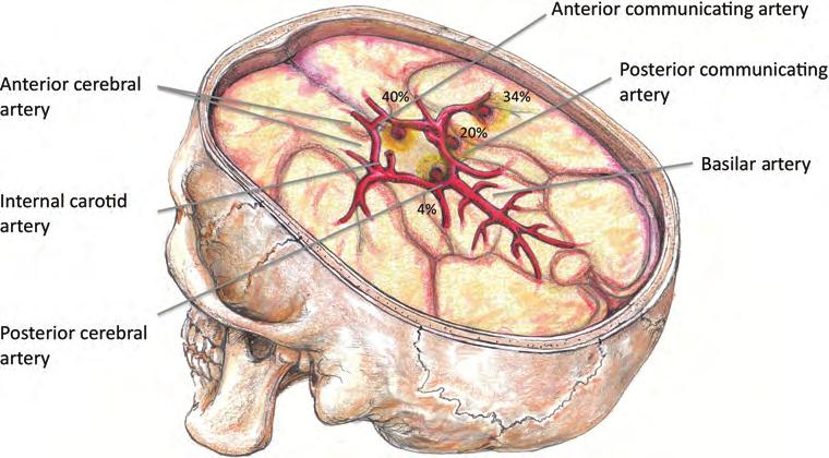 Fig 1 The intracranial arterial circulation showing the common locations of aneurysms.