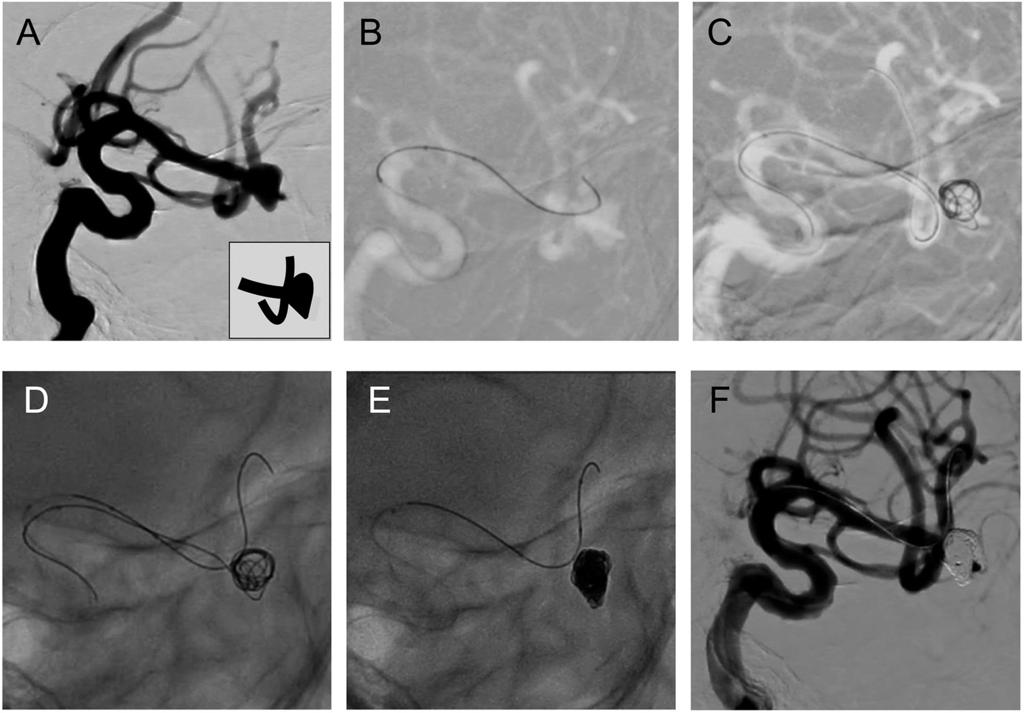 Usefulness of Coil-assisted Technique Fig. 1 Case 1: Left MCA aneurysm. (A) Pre-operative angiogram shows a wide-neck MCA aneurysm.