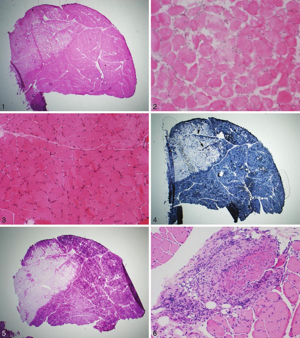 Figure 1. Vasculitis with focal ischemic necrosis of muscle.