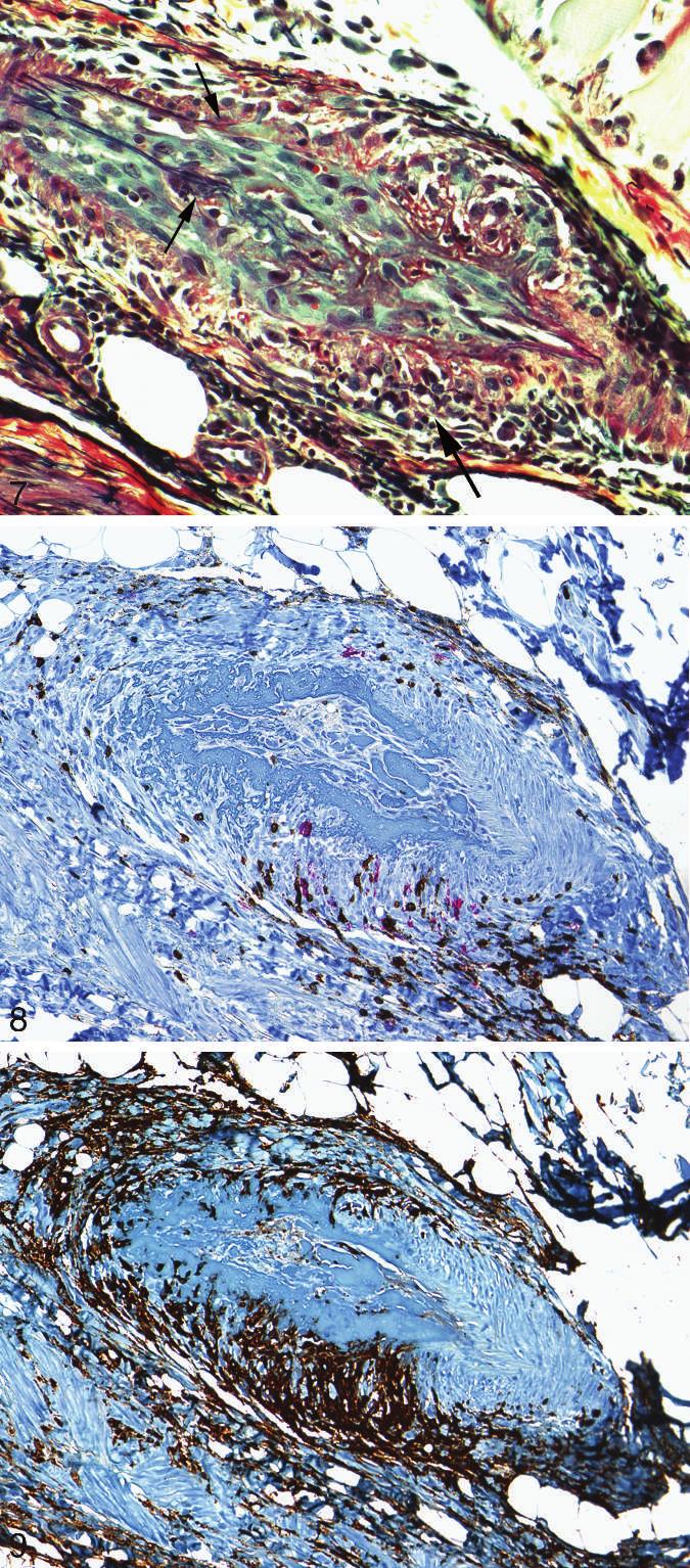 Figure 7. Vasculitis with focal ischemic necrosis of muscle.