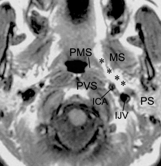 In tumors arising from the poststyloid parapharyngeal space, anteromedial displacement of the carotid sheath structures is frequent because the vagus nerve and sympathetic chain are posterior to the