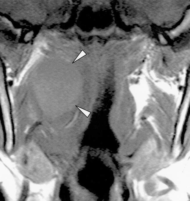 Imaging of Parapharyngeal Space Lesions Downloaded from www.ajronline.org by 46.3.205.55 on 02/06/18 from IP address 46.3.205.55. opyright RRS.