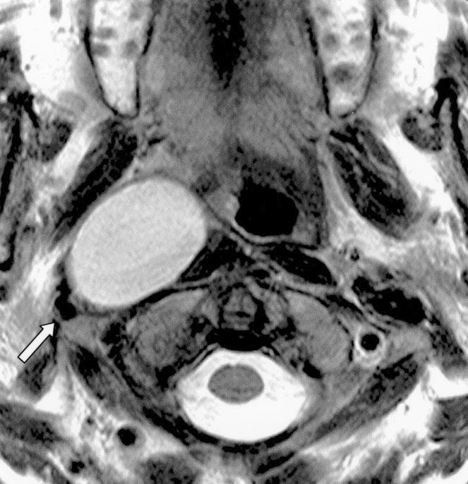 the parapharyngeal space fat. Obliteration of the parapharyngeal space fat plane is also frequently associated with infections of the masticator space.