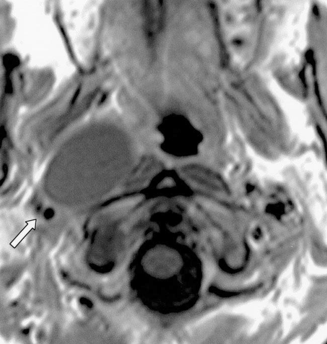 Second branchial cleft cyst in 35-year-old woman with multiple lower cranial palsies that subsided after removal of lesion.