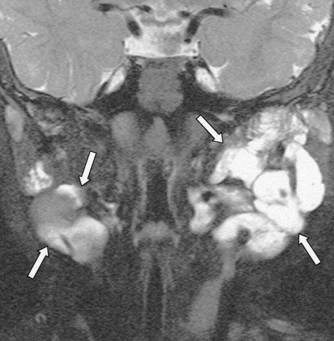 internal carotid artery and internal jugular vein to its posterolateral side (arrow)., T2-weighted spin-echo MR image shows mass is slightly hypointense to cerebrospinal fluid.