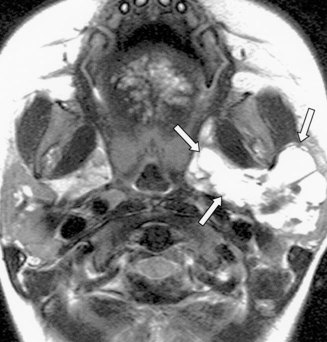 , Unenhanced coronal T1-weighted spin-echo MR image shows mass (arrowheads) occupying right parapharyngeal space from below skull base to upper level of submandibular gland.