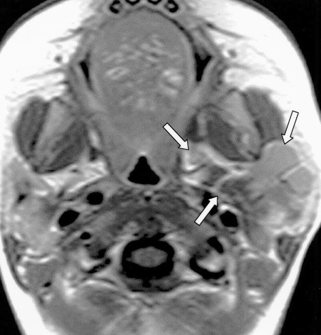 , xial enhanced T1-weighted spin-echo MR image shows multiloculated, nonenhancing cystic mass (arrows) in left prestyloid parapharyngeal space and in left parotid space.