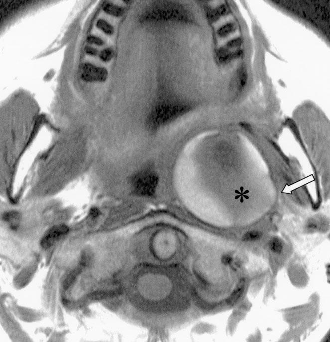 (asterisk) mass in left prestyloid parapharyngeal space. ystic contents were hemorrhagic on aspiration.