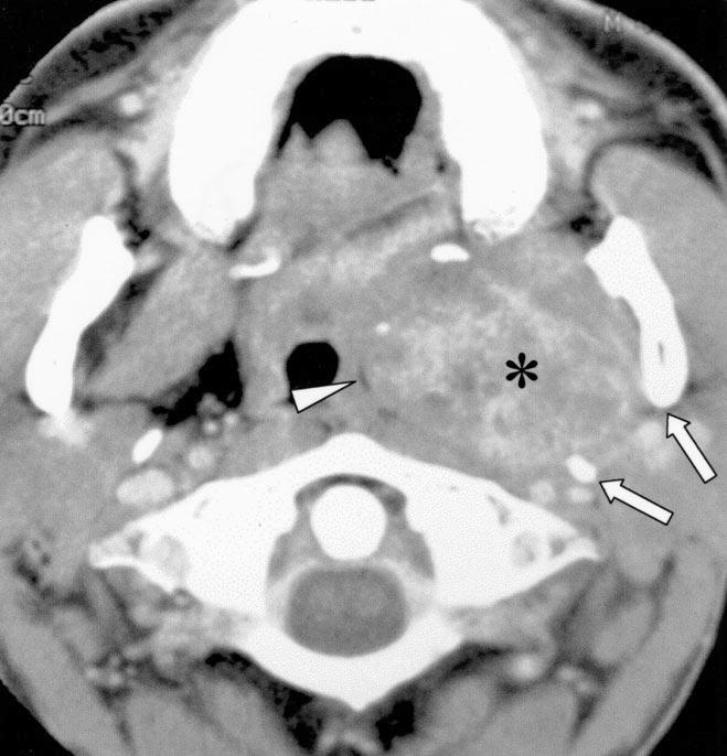 Stylomandibular tunnel (arrows) is widened by tumor, suggesting deep lobe parotid tumor.