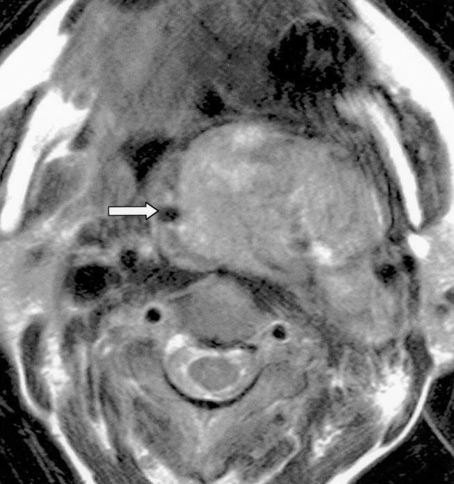gland is not seen, indicating parotid origin., xial enhanced T1-weighted spin-echo MR image shows inhomogeneously enhancing mass (asterisk).