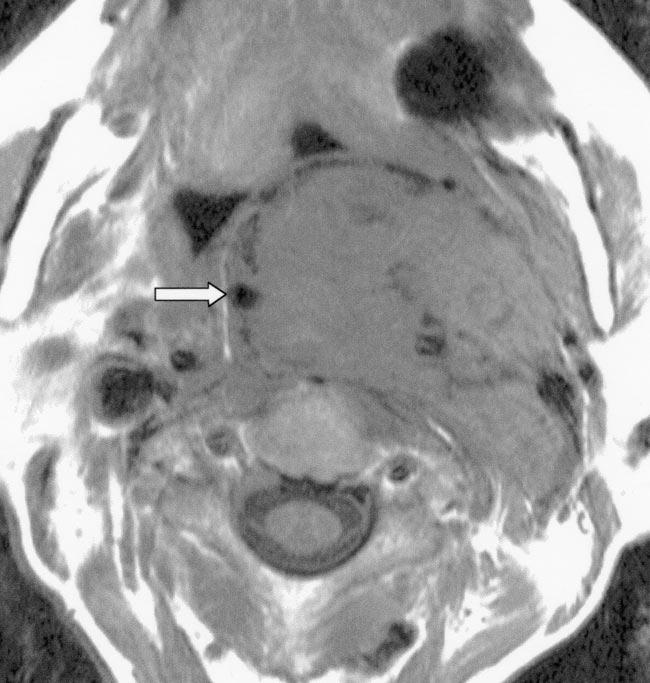 Paraganglioma in 61-year-old woman with left submandibular area swelling.