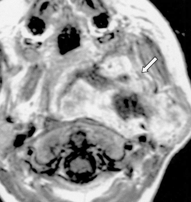 nteromedial displacement of internal carotid artery (arrow) indicates poststyloid parapharyngeal space origin of tumor.