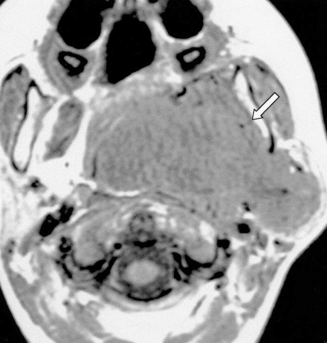 nteromedial displacement of internal carotid artery (arrow) can also be seen.