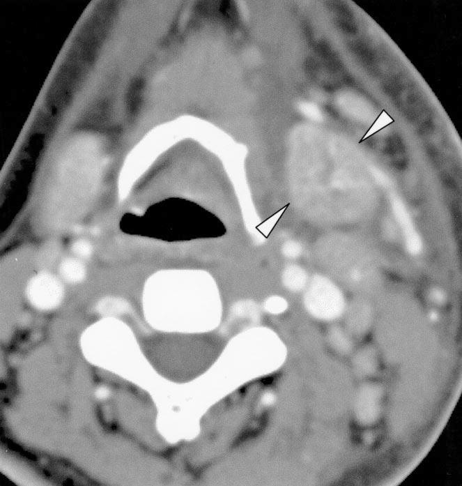 , oronal enhanced T1-weighted spin-echo MR image shows moderate enhancement of mass. References 1. hong VF, Fan YF. Radiology of the parapharyngeal space. ustralas Radiol 1998;42:278 283 2.