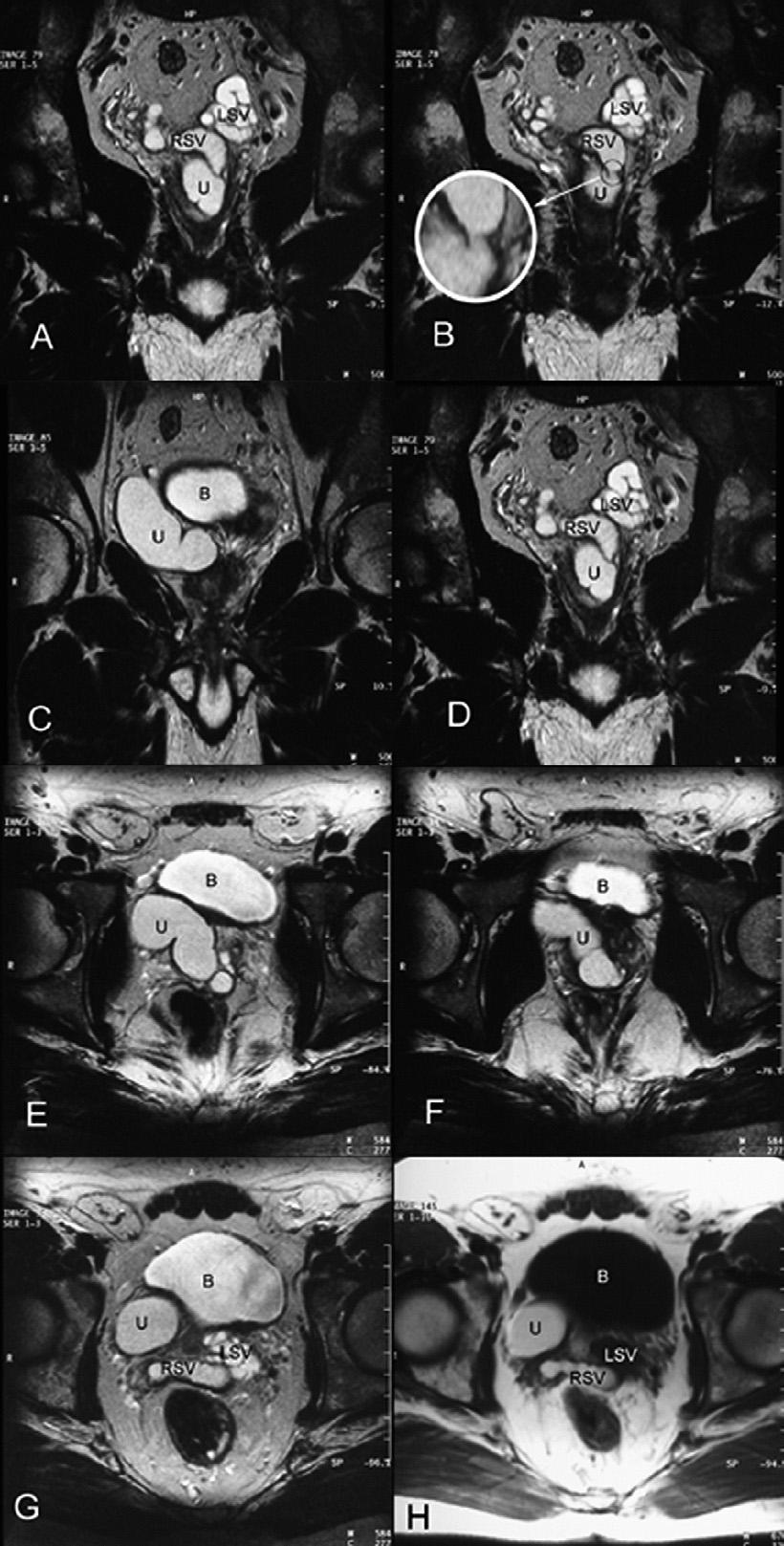270 european urology 52 (2007) 268 272 Fig. 2 (A) T2-weighted coronal scan. Ectopic ureter (U) passes through the posterior wall of the bladder and the right seminal vesicle (RSV).