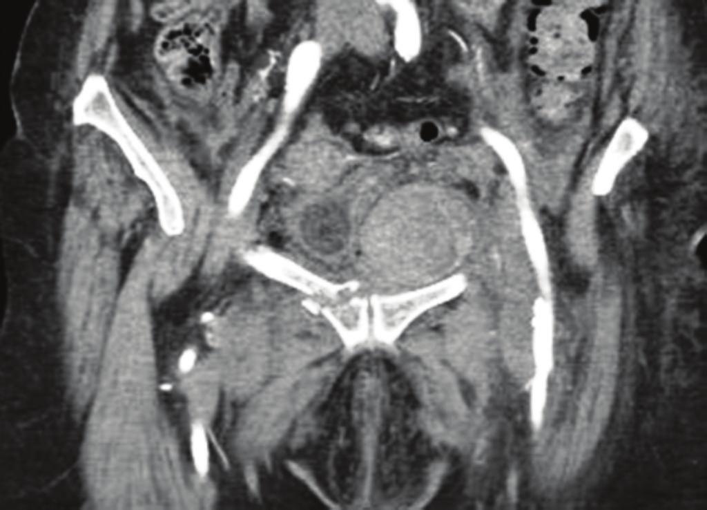 Discussion Figure 1: Anteroposterior pelvic radiograph revealing right superior and inferior pubic rami fractures.