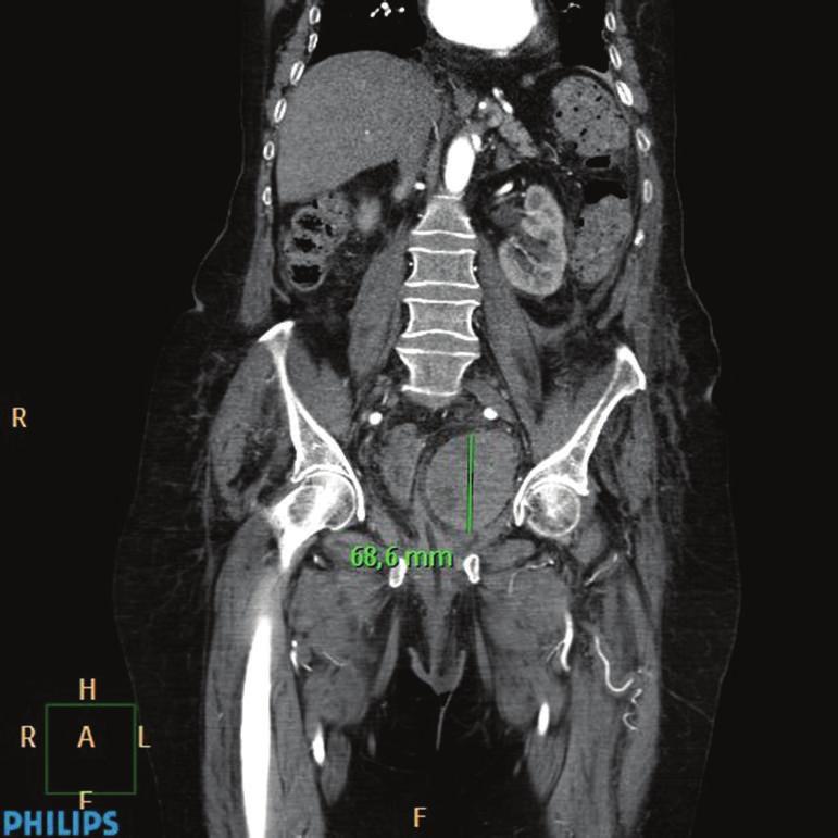 Bleeding arising from the pubic branch of the left inferior epigastric artery was treated by embolization, but the patient died from respiratory failure 48 hours after admission.
