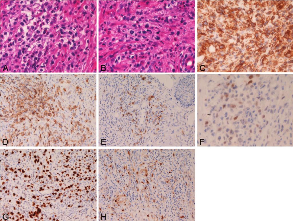 Figure 2. Histology of mycosis fungoides cells. They are composed of atypical lymphoma cells with hyperchromatic nuclei (A and B). Many mitotic figures were scattered (A and B).
