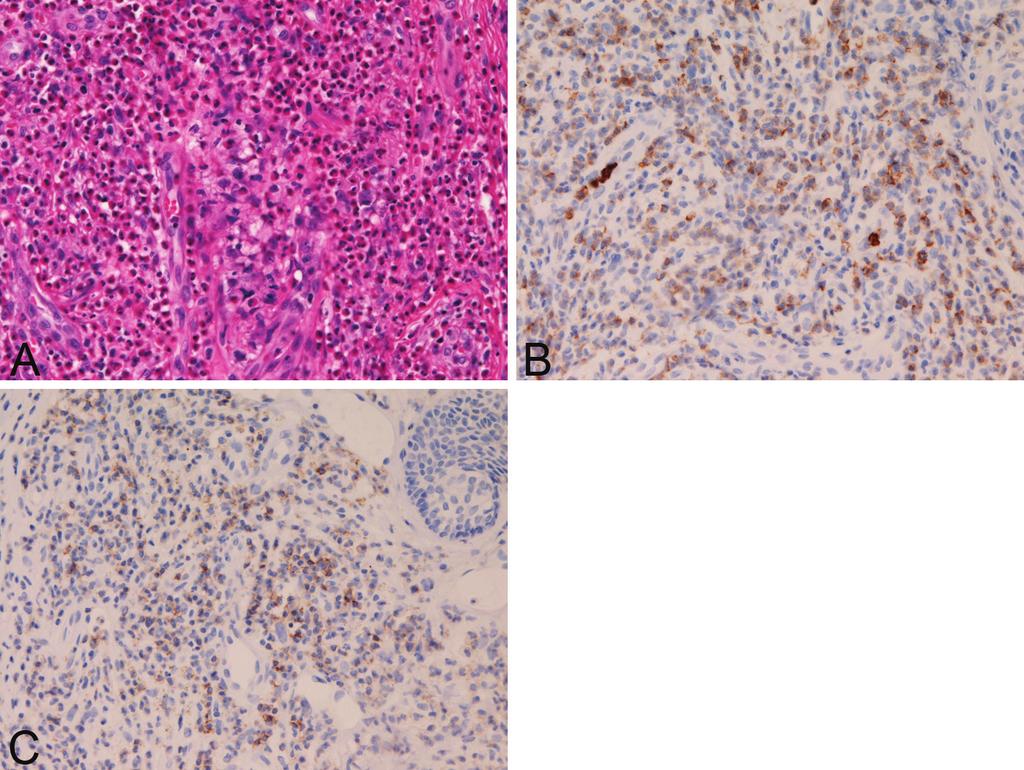 Figure 3. Histologic features of eosinophils. The lesions contained numerous mature eosinophils (A). They lacked cellular and nuclear atypia (A).