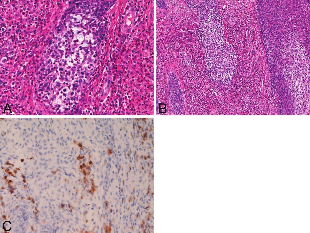 Figure 4. Folliculotropism of mycosis cells and eosinophils. The hair follicles are infiltrated by eosinophils (A) and by lymphoma cells (B). Follicular mucinosis is seen (A and B).