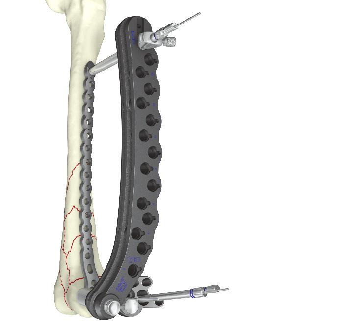 Correct proximal plate placement should also be re-confirmed at this point to make sure the plate shaft is properly aligned over the lateral surface of the femoral shaft.