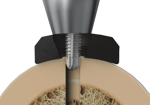 Stop power insertion approximately 1cm before engaging the screw head in the plate.
