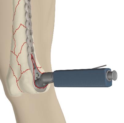 Use the leg elevator to provide leg support and knee flexion to allow fluoroscopy of the femur in both the AP and lateral views.