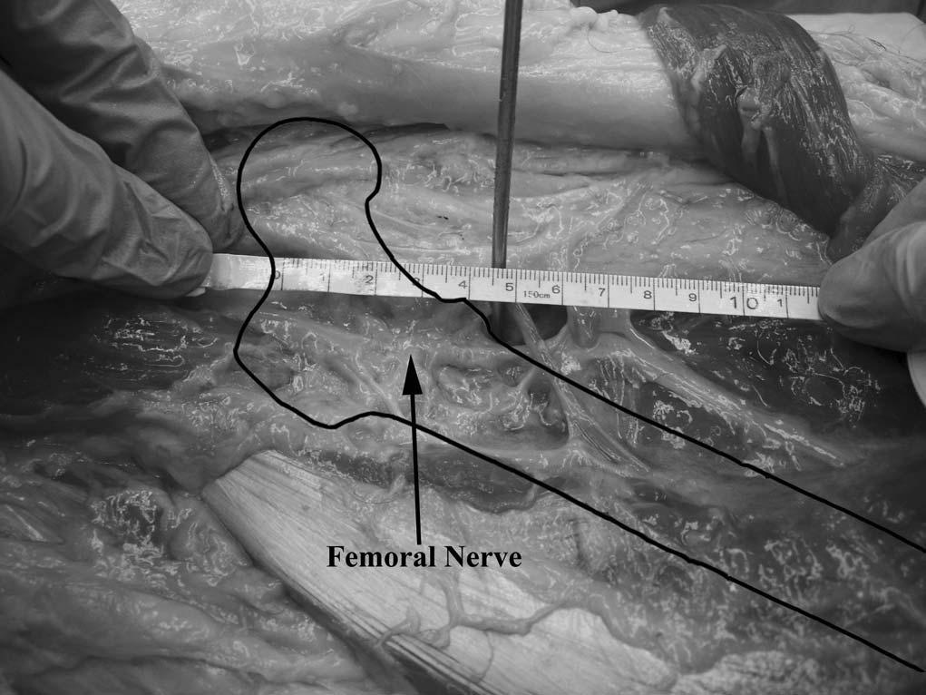 J Orthop Trauma Volume 26, Number 11, November 2012 Safe Zone for External Fixator Pins in Femur anterior femur was 4.35 (range, 2 6).