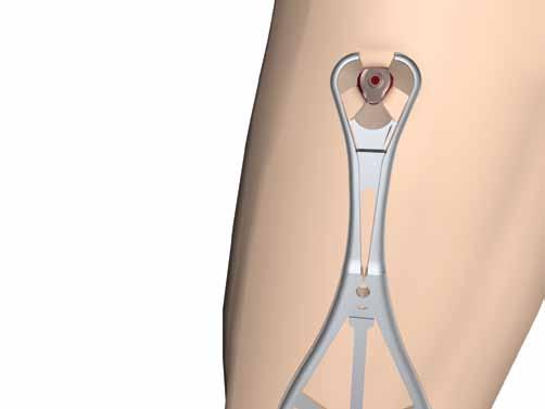 The Standard Percutaneous Drill Sleeve (REF 702710) or Neutral Percutaneous Drill Sleeve (REF 702958) in conjunction with the Drill Sleeve Handle (REF 702822)