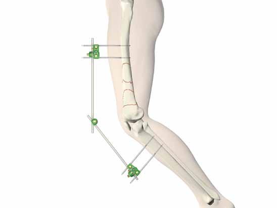 Operative Technique General Guidelines Patient Positioning: Surgical Approach: Instrument / Screw Set: Supine with option to flex the knee up to 60 over a leg support.