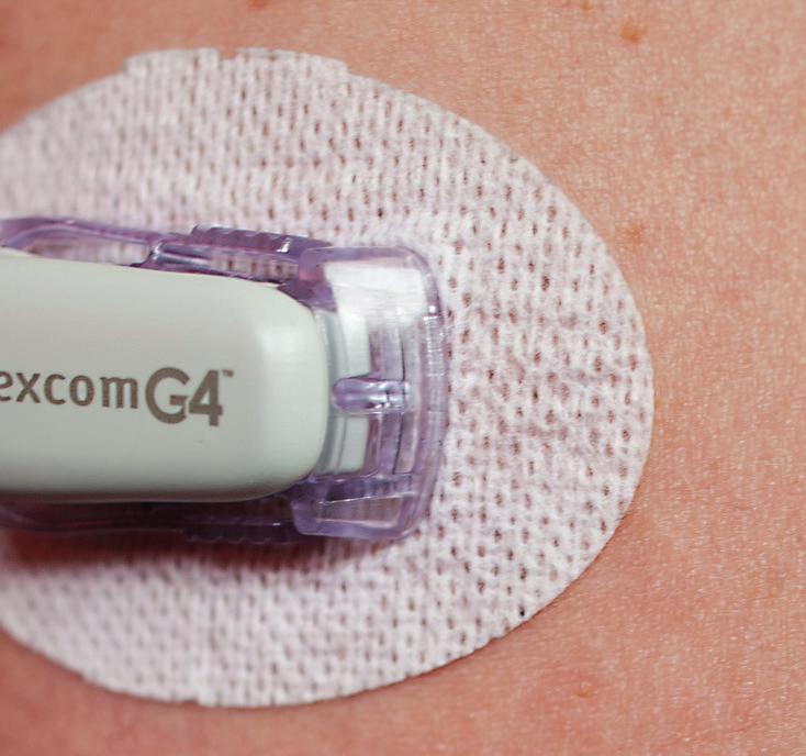 Using CGM for your diabetes clinical trial As we ve said, the receivers for the latest CGM units include screens displaying visual feedback about how blood glucose levels are changing over the day.